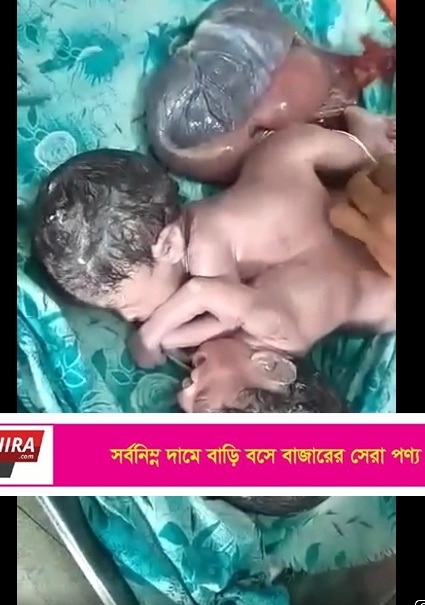 শ্যামনগরে একটি হৃদপিণ্ড নিয়ে যমজ দুই কন্যা শিশুর জন্ম !