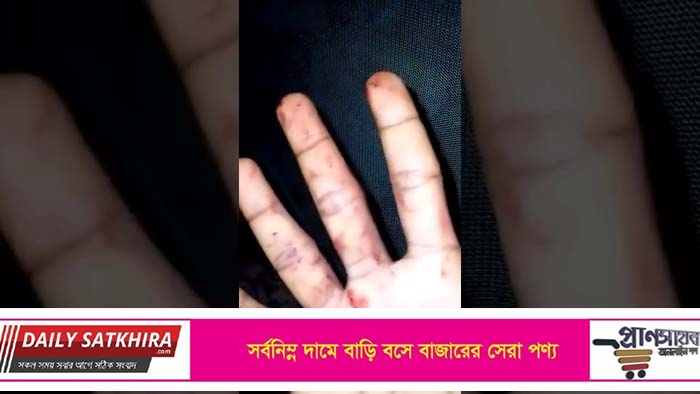 সাতক্ষীরায় বিচালি কাটা মেশিনে ক্ষত-বিক্ষত কিশোরের হাত !
