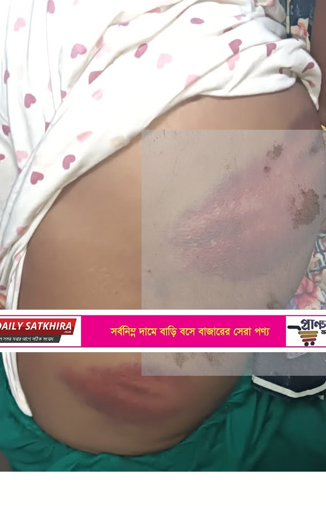 কাটিয়ায় নারীসহ ৫ সদস্যকে পিটিয়ে গুরুতর জখম: মামলা করায় হুমকির অভিযোগ