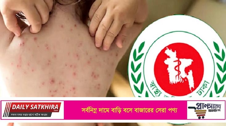হাম উপসর্গে আরও ৩ শিশুর মৃত্যু, নতুন আক্রান্ত ৭৮৬